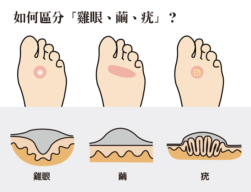 如何區分 繭 雞眼 疣 Dr Foot 達特富科技股份有限公司 足弓鞋墊 訂做鞋墊 矯正鞋墊